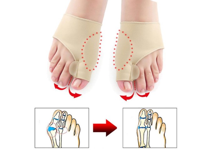 Orthopedic Bunion Corrector Sleeve